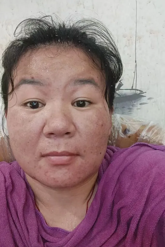 Ánh gái xấu nhiều mụn